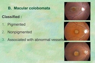 Classified :
1. Pigmented
2. Nonpigmented
3. Associated with abnormal vessels
B. Macular colobomata
 