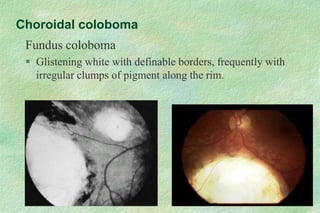 Choroidal coloboma
Fundus coloboma
 Glistening white with definable borders, frequently with
irregular clumps of pigment along the rim.
 