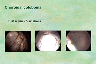  Margins - Variations
Choroidal coloboma
 