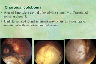  Area of bare sclera devoid of overlying normally differentiated
retina or choroid.
 Undifferentiated retinal remnants may persist as a membrane,
sometimes with associated retinal vessels.
Choroidal coloboma
 