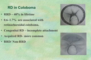 RD in Coloboma
 RRD – 40% in lifetime
 0.6–1.7% are associated with
retinochoroidal coloboma.
 Congenital RD – incomplete attachment
 Acquired RD– more common
 RRD/ Non-RRD
 