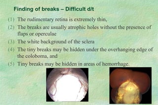 Finding of breaks – Difficult d/t
(1) The rudimentary retina is extremely thin,
(2) The breaks are usually atrophic holes without the presence of
flaps or operculae
(3) The white background of the sclera
(4) The tiny breaks may be hidden under the overhanging edge of
the coloboma, and
(5) Tiny breaks may be hidden in areas of hemorrhage.
 