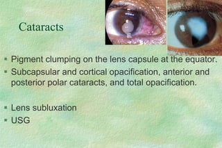 Cataracts
 Pigment clumping on the lens capsule at the equator.
 Subcapsular and cortical opacification, anterior and
posterior polar cataracts, and total opacification.
 Lens subluxation
 USG
 