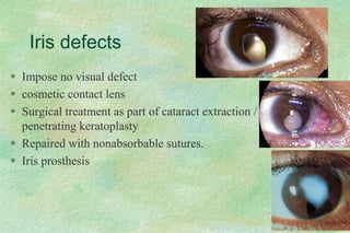Iris defects
 Impose no visual defect
 cosmetic contact lens
 Surgical treatment as part of cataract extraction /
penetrating keratoplasty
 Repaired with nonabsorbable sutures.
 Iris prosthesis
 