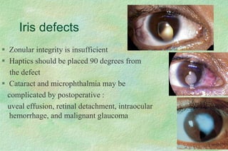 Iris defects
 Zonular integrity is insufficient
 Haptics should be placed 90 degrees from
the defect
 Cataract and microphthalmia may be
complicated by postoperative :
uveal effusion, retinal detachment, intraocular
hemorrhage, and malignant glaucoma
 