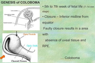 GENESIS of COLOBOMA
• 5th to 7th week of fetal life (7–14 mm
stage)
• Closure – Inferior midline from
equator
Faulty closure results in a area
with
absence of uveal tissue and
RPE.
… Coloboma
 