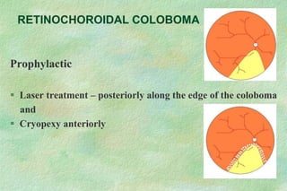 RETINOCHOROIDAL COLOBOMA
Prophylactic
 Laser treatment – posteriorly along the edge of the coloboma
and
 Cryopexy anteriorly
 