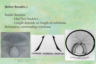 Wang et al . Tr. Am. Ophth Soc. vol.
LXXXIII, 1985
Better Results:::
Radial Buckles:
- One/Two buckle/s
- Length depends on length of coloboma
Retinopexy surrounding coloboma
 