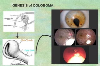 GENESIS of COLOBOMA
 