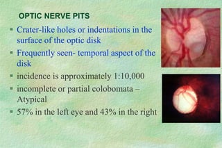 OPTIC NERVE PITS
 Crater-like holes or indentations in the
surface of the optic disk
 Frequently seen- temporal aspect of the
disk
 incidence is approximately 1:10,000
 incomplete or partial colobomata –
Atypical
 57% in the left eye and 43% in the right
 
