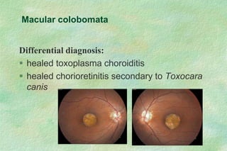 Differential diagnosis:
 healed toxoplasma choroiditis
 healed chorioretinitis secondary to Toxocara
canis
Macular colobomata
 
