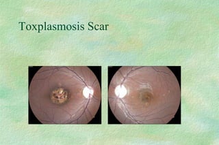 Toxplasmosis Scar
 