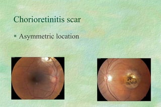 Chorioretinitis scar
 Asymmetric location
 