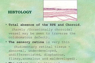 HISTOLOGY
 Total absence of the RPE and Choroid.
(Rarely /Occasionally choroidal
vessel may be seen to traverse the
colobomatous defect).
 The sensory retina is very thin
(Rudimentary retinal tissue -
abnormal, underdeveloped,
undifferentiated, diaphanous,
flimsy,anomalous and maldeveloped).
 