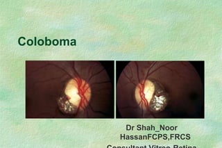 Dr Shah_Noor
HassanFCPS,FRCS
Coloboma
 