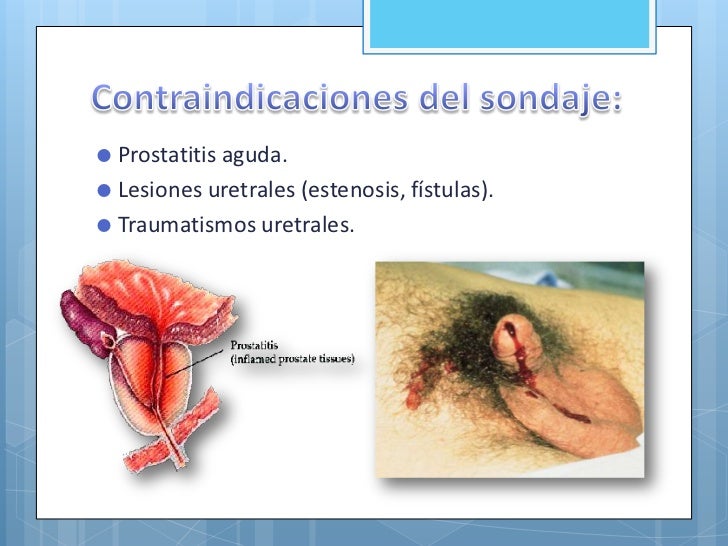 Resultado de imagen para SONDA VESICAL