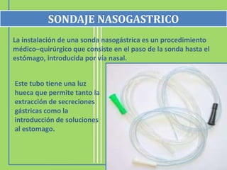 La instalación de una sonda nasogástrica es un procedimiento
médico–quirúrgico que consiste en el paso de la sonda hasta el
estómago, introducida por vía nasal.
SONDAJE NASOGASTRICO
Este tubo tiene una luz
hueca que permite tanto la
extracción de secreciones
gástricas como la
introducción de soluciones
al estomago.
 