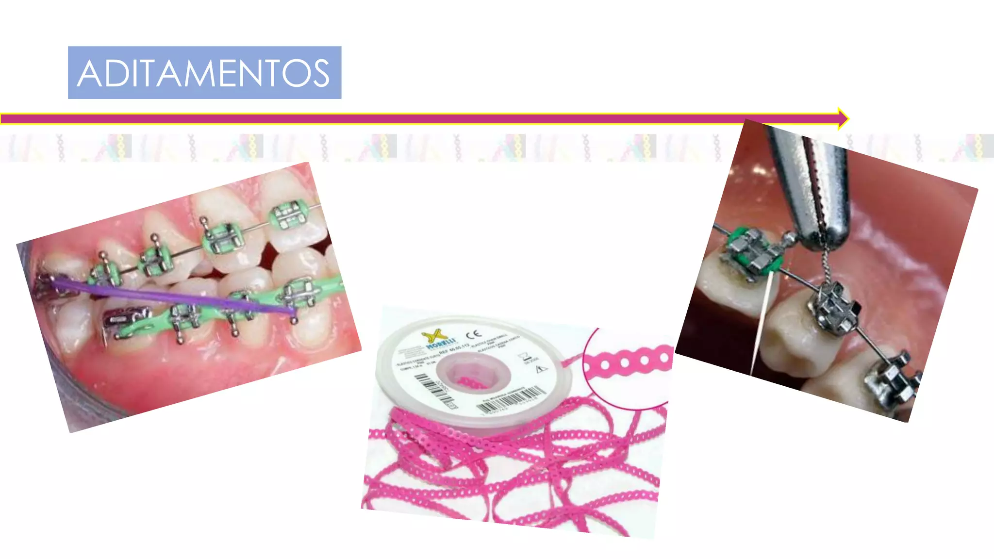 COLOCACION DE BRACKETS Y BANDAS | PPTX
