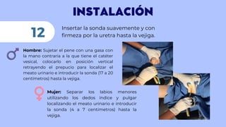 INSTALACIÓN
Insertar la sonda suavemente y con
firmeza por la uretra hasta la vejiga.
12
Mujer: Separar los labios menores
utilizando los dedos índice y pulgar
localizando el meato urinario e introducir
la sonda (4 a 7 centímetros) hasta la
vejiga.
Hombre: Sujetar el pene con una gasa con
la mano contraria a la que tiene el catéter
vesical, colocarlo en posición vertical
retrayendo el prepucio para localizar el
meato urinario e introducir la sonda (17 a 20
centímetros) hasta la vejiga.
 