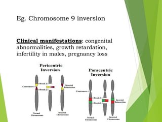 Eg. Chromosome 9 inversion
Clinical manifestations: congenital
abnormalities, growth retardation,
infertility in males, pregnancy loss
 