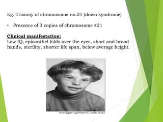 Eg. Trisomy of chromosome no.21 (down syndrome)
• Presence of 3 copies of chromosome #21
Clinical manifestation:
Low IQ, epicanthel folds over the eyes, short and broad
hands, sterility, shorter life span, below average height.
 