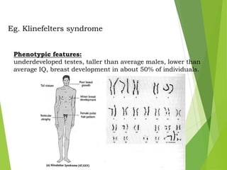 Eg. Klinefelters syndrome
Phenotypic features:
underdeveloped testes, taller than average males, lower than
average IQ, breast development in about 50% of individuals.
 
