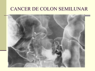 CANCER DE COLON SEMILUNAR 