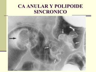 CA ANULAR Y POLIPOIDE SINCRONICO 