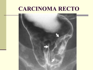 CARCINOMA RECTO 