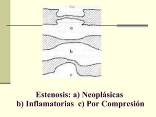 Estenosis: a) Neoplásicas  b) Inflamatorias  c) Por Compresión 