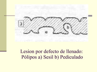 Lesion por defecto de llenado:  Pólipos a) Sesil b) Pediculado 