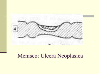 Menisco: Ulcera Neoplasica 