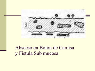 Absceso en Botón de Camisa  y Fístula Sub mucosa 