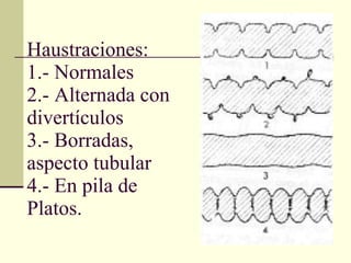 Haustraciones: 1.- Normales  2.- Alternada con divertículos  3.- Borradas, aspecto tubular 4.- En pila de Platos. 