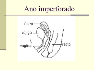Ano imperforado 