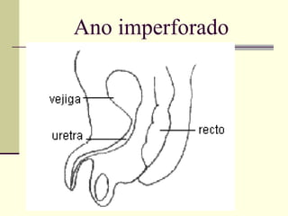 Ano imperforado 