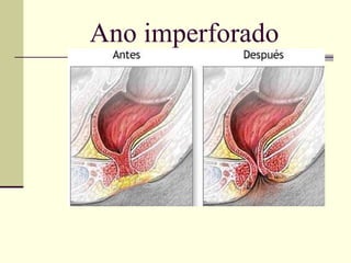 Ano imperforado 