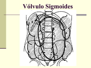 Vólvulo Sigmoides 