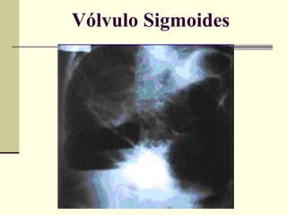 Vólvulo Sigmoides 