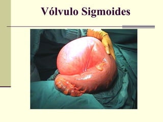 Vólvulo Sigmoides 