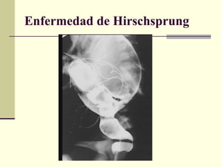 Enfermedad de Hirschsprung 
