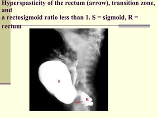 Hyperspasticity of the rectum (arrow), transition zone, and  a rectosigmoid ratio less than 1. S = sigmoid, R = rectum   