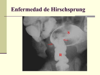 Enfermedad de Hirschsprung 