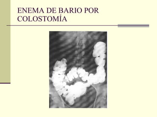 ENEMA DE BARIO POR COLOSTOMÍA 