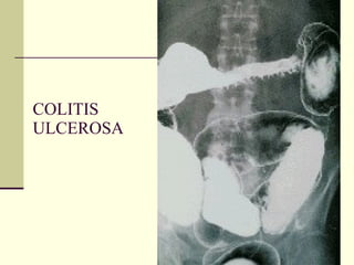 COLITIS ULCEROSA 