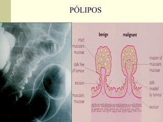 PÓLIPOS 