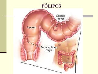PÓLIPOS 