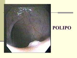 POLIPO 