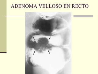 ADENOMA VELLOSO EN RECTO 