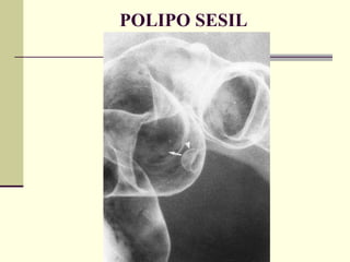 POLIPO SESIL 